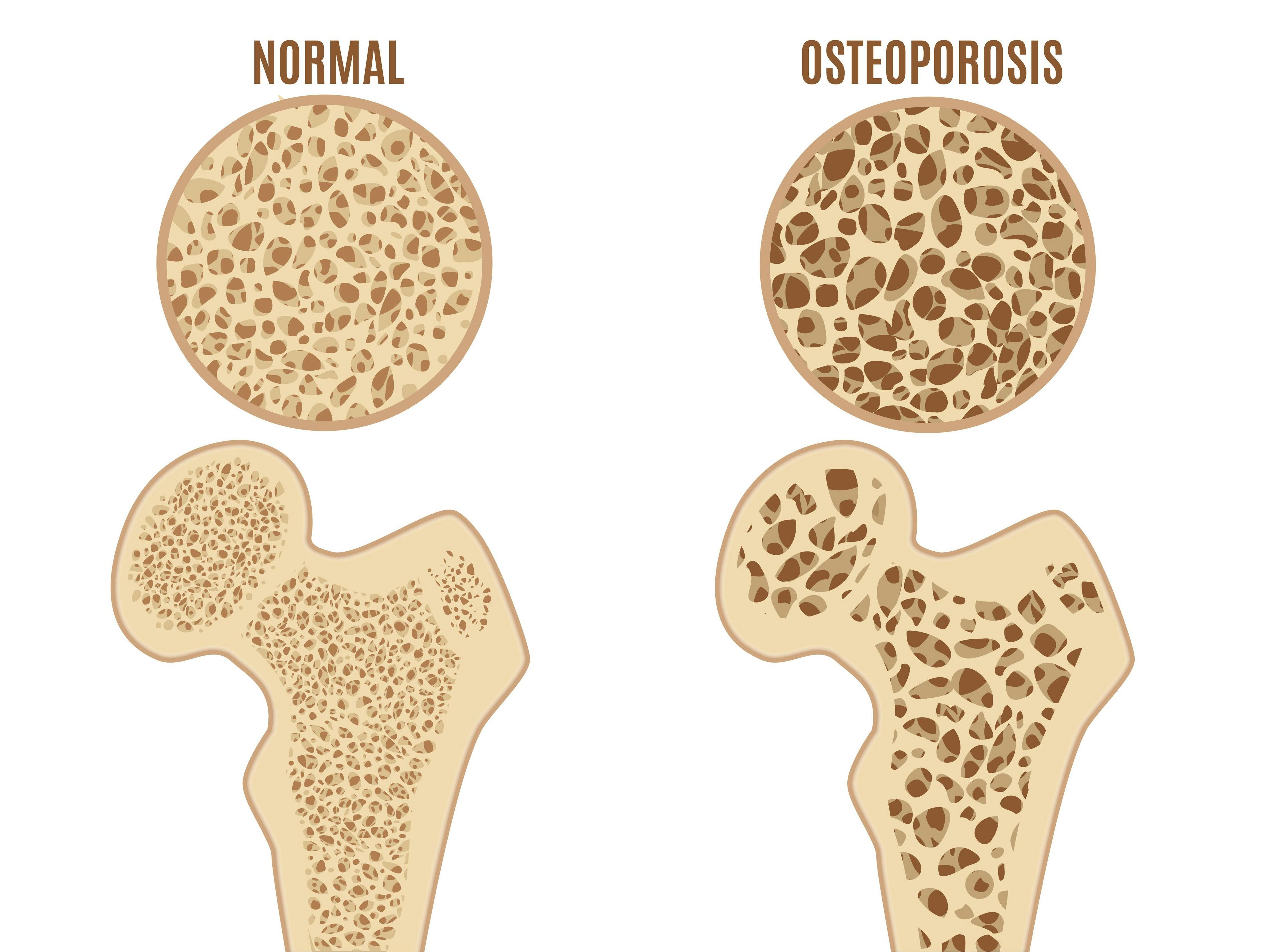 osteoporosis bone difference | Image credit: bigmouse108 - stock.adobe.com