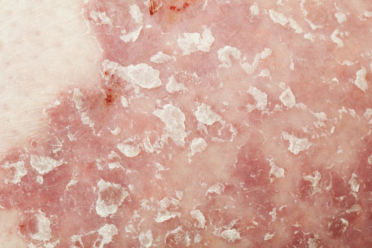 No Higher Risk of Cancer for Patients With Psoriasis Treated With Biologics, Analysis Finds