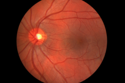 Infliximab Shows Promise in Treating Retinal Disorders