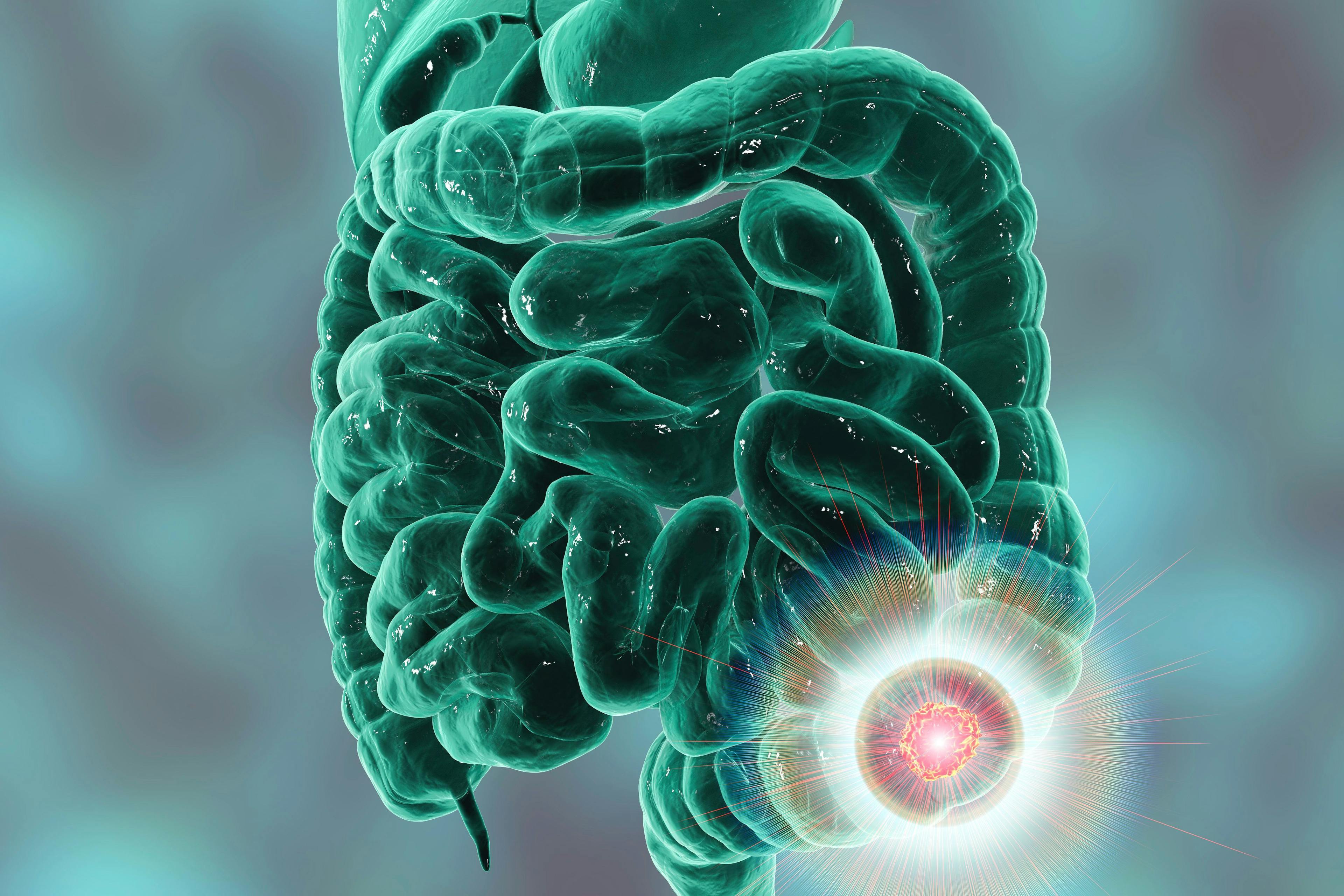 colorectal cancer | Image credit: Dr_Microbe - stock.adobe.com