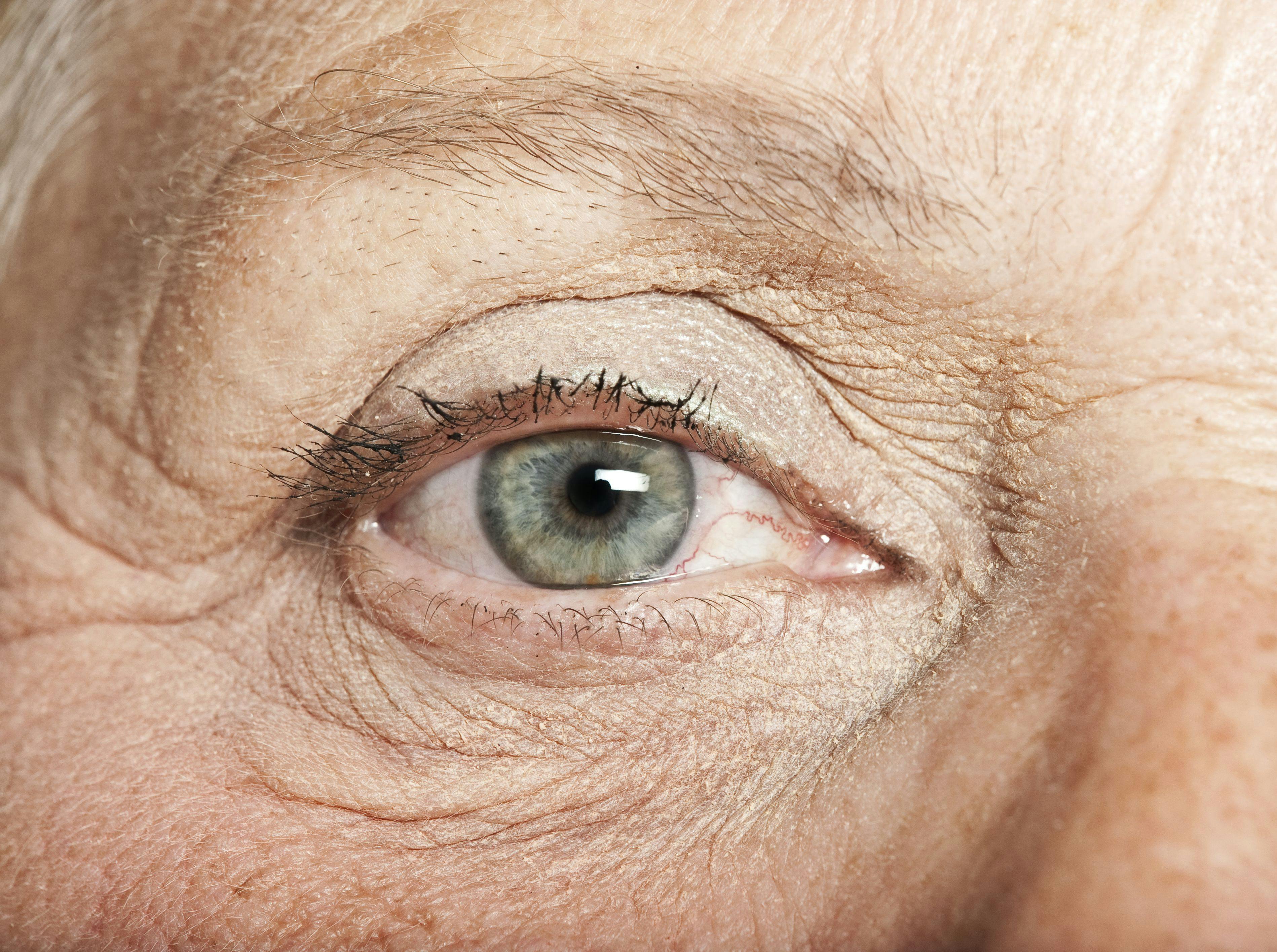 Untreated age-related macular degeneration (AMD) is the leading cause of irreversible blindness or vision loss in people over 60 years of age. Although wet AMD, accounts for only 10% of AMD cases, this subset of the disease results in 90% of legal blindness as a result of AMD.