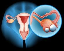 Bevacizumab Plus Chemotherapy Improves PFS in Early Ovarian Cancer