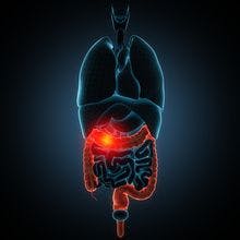 Researchers Report Positive Early Data for SB2 in Treating IBD