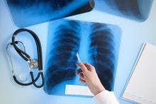 Risk of TB High in Indian Patients With IBD Who Receive Infliximab