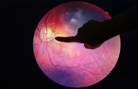 Anti-VEGF Drugs Not Associated With Increased Risk of AEs in Eye Diseases