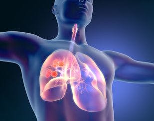Biosimilar Filgrastim Similar to Reference Product When Used in NSCLC