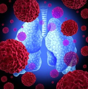 Researchers Provide Updates on Benefits of Bevacizumab in NSCLC
