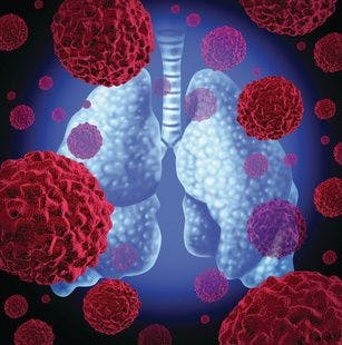 Bevacizumab Could Help Patients With NSCLC Who Cannot Receive PD-1 Inhibitors