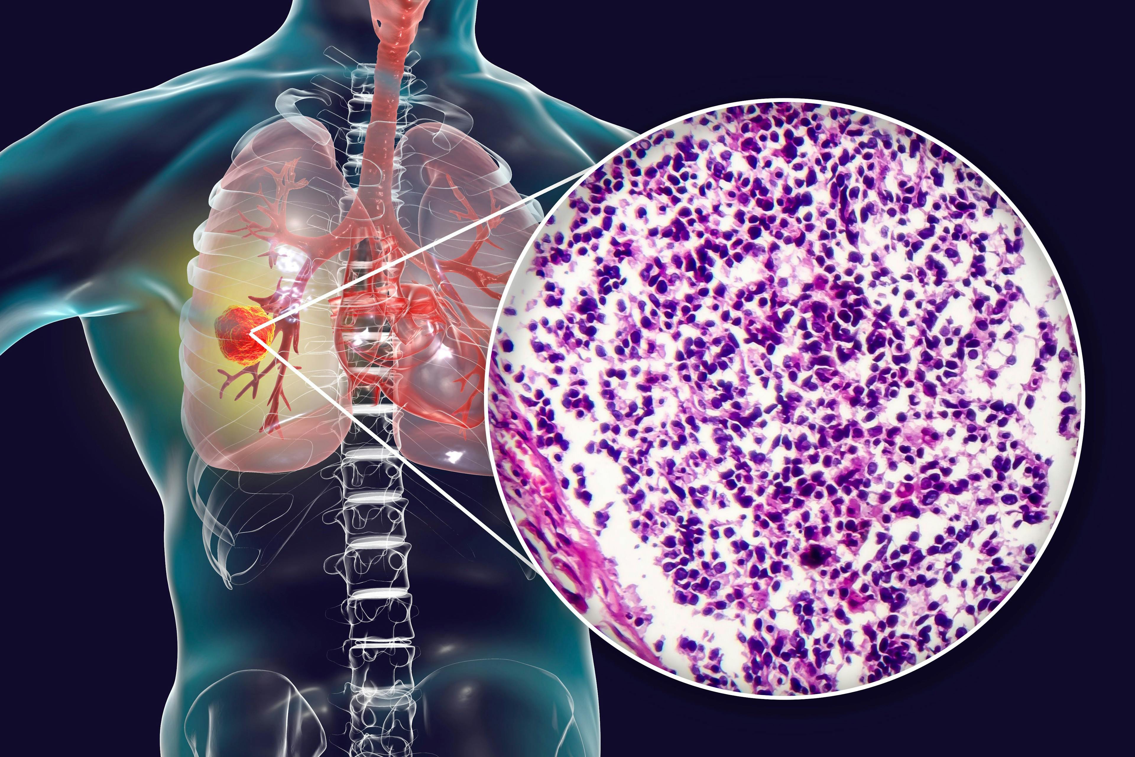 lung cancer | Image credit: Dr_Microbe - stock.adobe.com